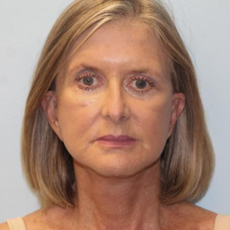 After image 1 Case #108171 - Facelift, Browlift, & Blepharoplasty