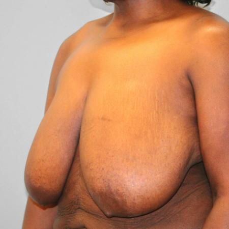 Before image 2 Case #108256 - Breast Reduction