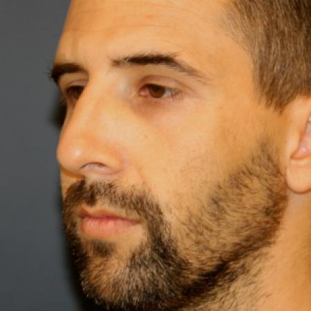 Before image 2 Case #107641 - Rhinoplasty with Chin Implant