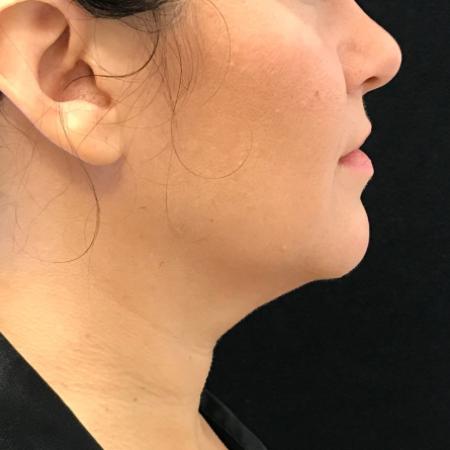 Before image 1 Case #108011 - CoolSculpting for Double Chin