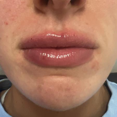 After image 1 Case #108016 - Lip Filler