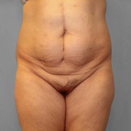Before image 1 Case #108231 - Abdominoplasty & Lipo