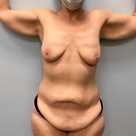 Before image 1 Case #108161 - Tummy Tuck & Arm Lift