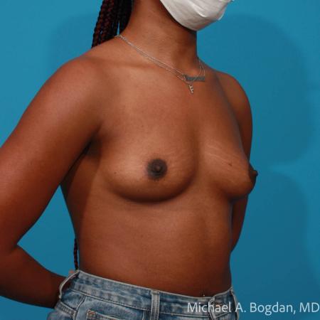 Before image 2 Case #108351 - Breast Augmentation