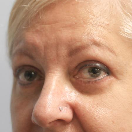 After image 2 Case #108211 - Blepharoplasty