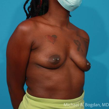 Before image 2 Case #108346 - Breast Augmentation