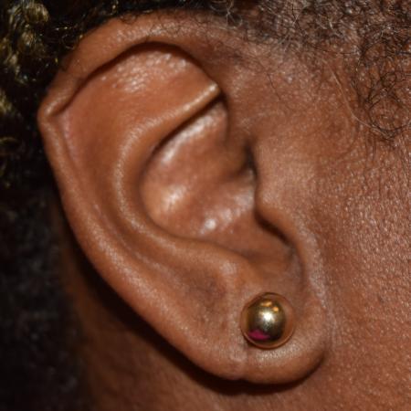 After image 1 Case #107911 - Bilateral Earlobe Repair & Ear Piercing