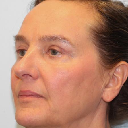 After image 2 Case #108121 - Upper and Lower Blepharoplasty