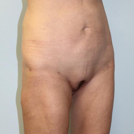 After image 2 Case #108216 - Liposuction