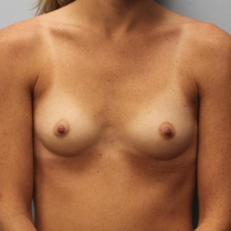 Before image 1 Case #107531 - Breast Augmentation