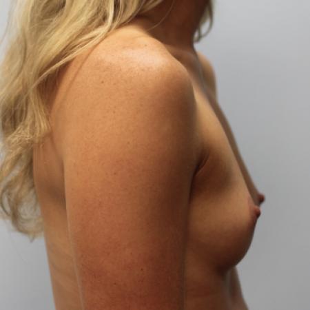 Before image 3 Case #108196 - Breast Augmentation