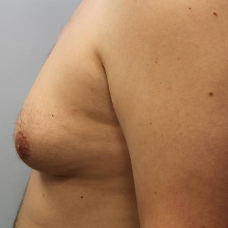 Before image 3 Case #108141 - Gynecomastia