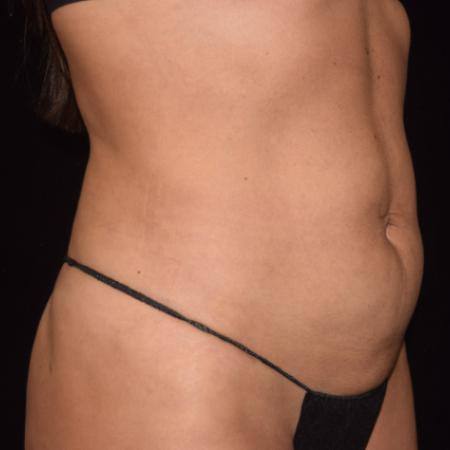After image 3 Case #107886 - Female Liposuction & Fat Transfer