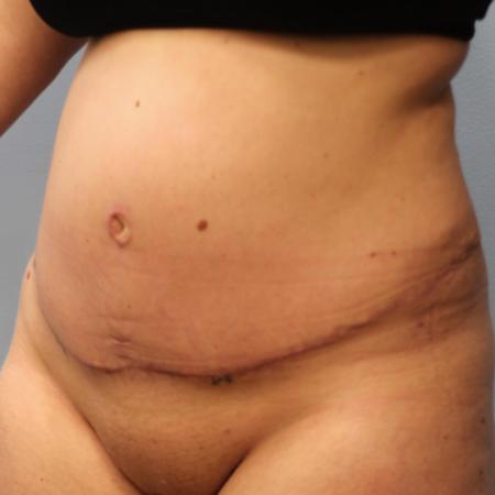 After image 2 Case #108051 - Tummy Tuck