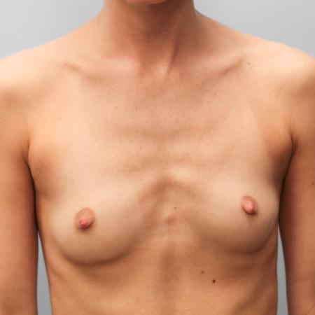 Before image 1 Case #108071 - Breast Augmentation
