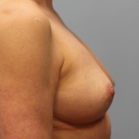 After image 3 Case #107571 - Breast Revision