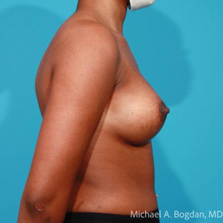 After image 3 Case #108351 - Breast Augmentation