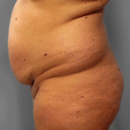 Before image 3 Case #108051 - Tummy Tuck