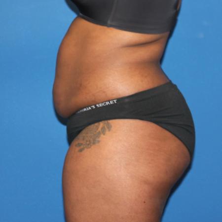 Before image 5 Case #107521 - Mommy Makeover