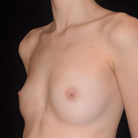 Before image 2 Case #107901 - Underarm Endoscopic Breast Augmentation
