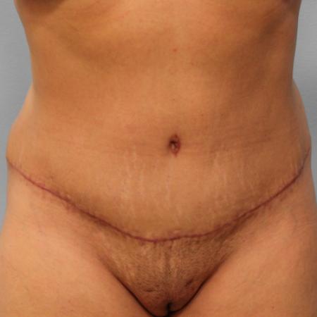 After image 1 Case #108106 - Tummy Tuck