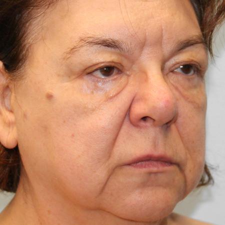 Before image 2 Case #107686 - Facelift