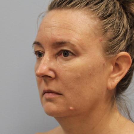 Before image 2 Case #108166 - Browlift & Belpharoplasty