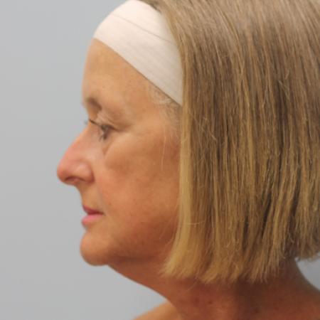 Before image 3 Case #108171 - Facelift, Browlift, & Blepharoplasty