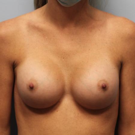 After image 1 Case #107531 - Breast Augmentation