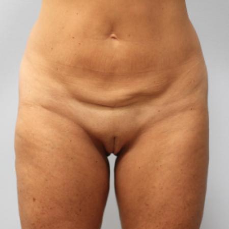Before image 1 Case #107591 - Body Lift