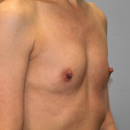 Before image 2 Case #108276 - Breast Augmentation