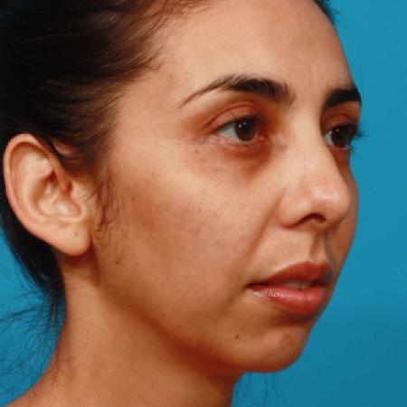 Before image 2 Case #108301 - Chin Augmentation