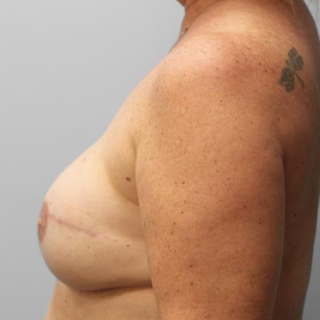 After image 3 Case #107961 - Breast Reconstruction