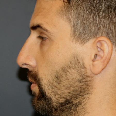 Before image 1 Case #107641 - Rhinoplasty with Chin Implant