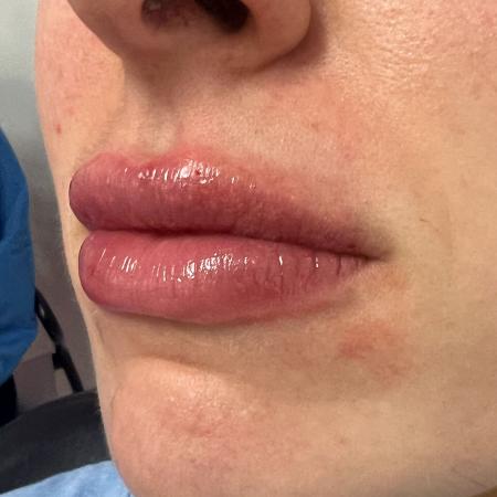 After image 2 Case #108016 - Lip Filler