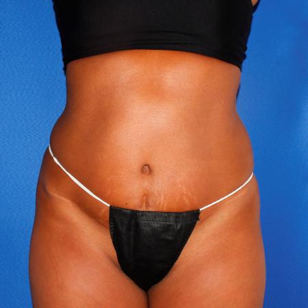Before image 1 Case #107826 - Liposuction Abdomen/Flanks with Abdominal Etching