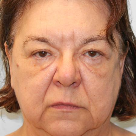 Before image 1 Case #107686 - Facelift