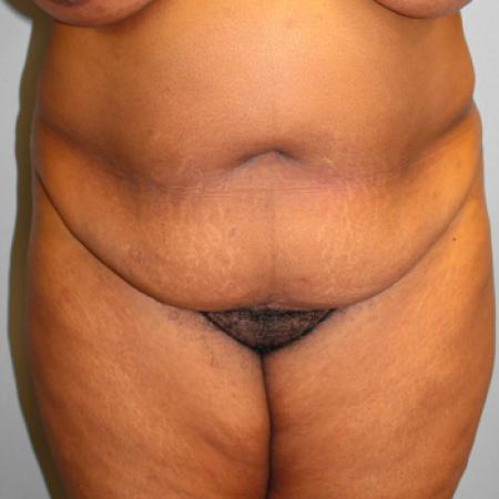 Before image 1 Case #108226 - Tummy Tuck & Lipo