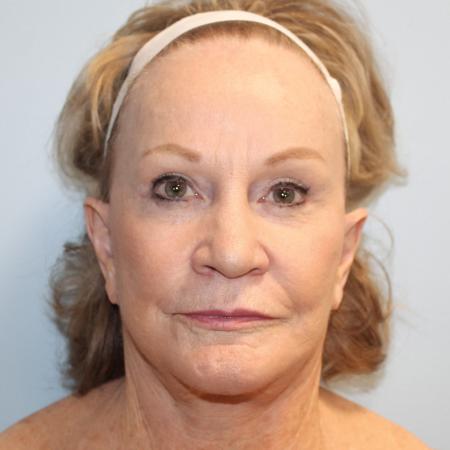 After image 1 Case #107611 - Facelift