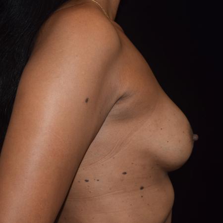 After Case #107891 - Endoscopic Breast Augmentation Revision