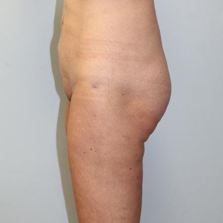 After image 3 Case #108216 - Liposuction