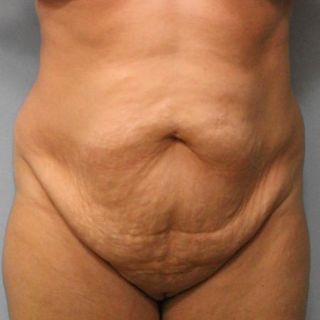 Before image 1 Case #108106 - Tummy Tuck