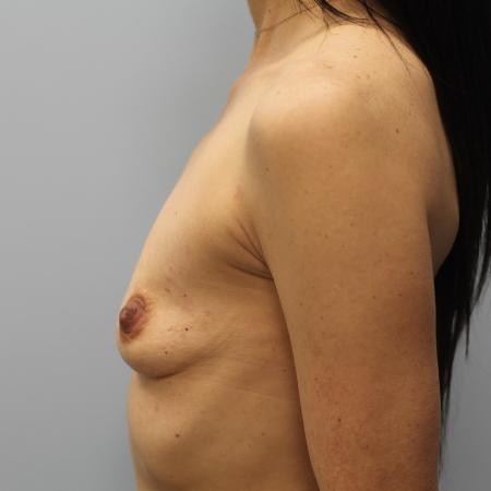 Before image 3 Case #107631 - Breast Augmentation