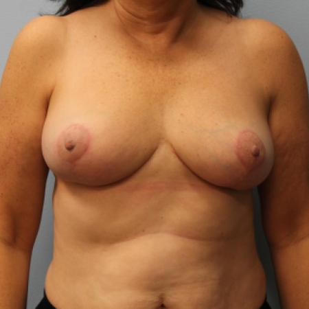 After image 1 Case #108246 - Breast Reduction