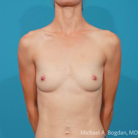 Before image 1 Case #108306 - Breast Augmentation