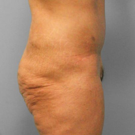 After image 3 Case #108231 - Abdominoplasty & Lipo