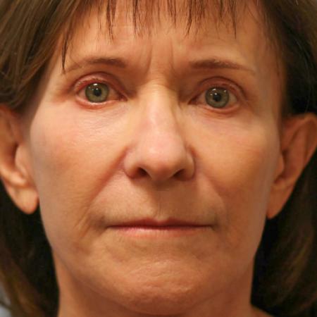 After image 1 Case #108286 - Facelift & Blepharoplasty