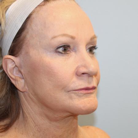 After image 2 Case #107611 - Facelift