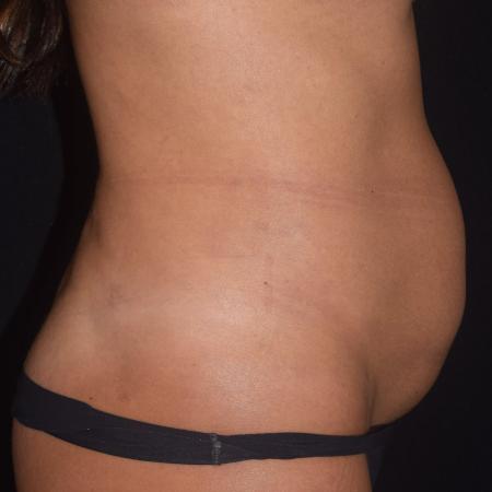 Before image 2 Case #107886 - Female Liposuction & Fat Transfer