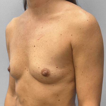 Before image 2 Case #108126 - Breast Augmentation